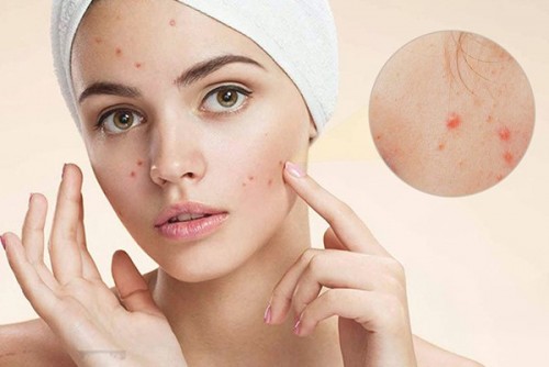ĐIỀU TRỊ CÁC LOẠI MỤN