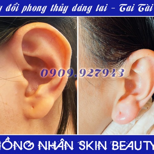 TIÊM FILLER LÀM ĐẦY TRÊN MẶT