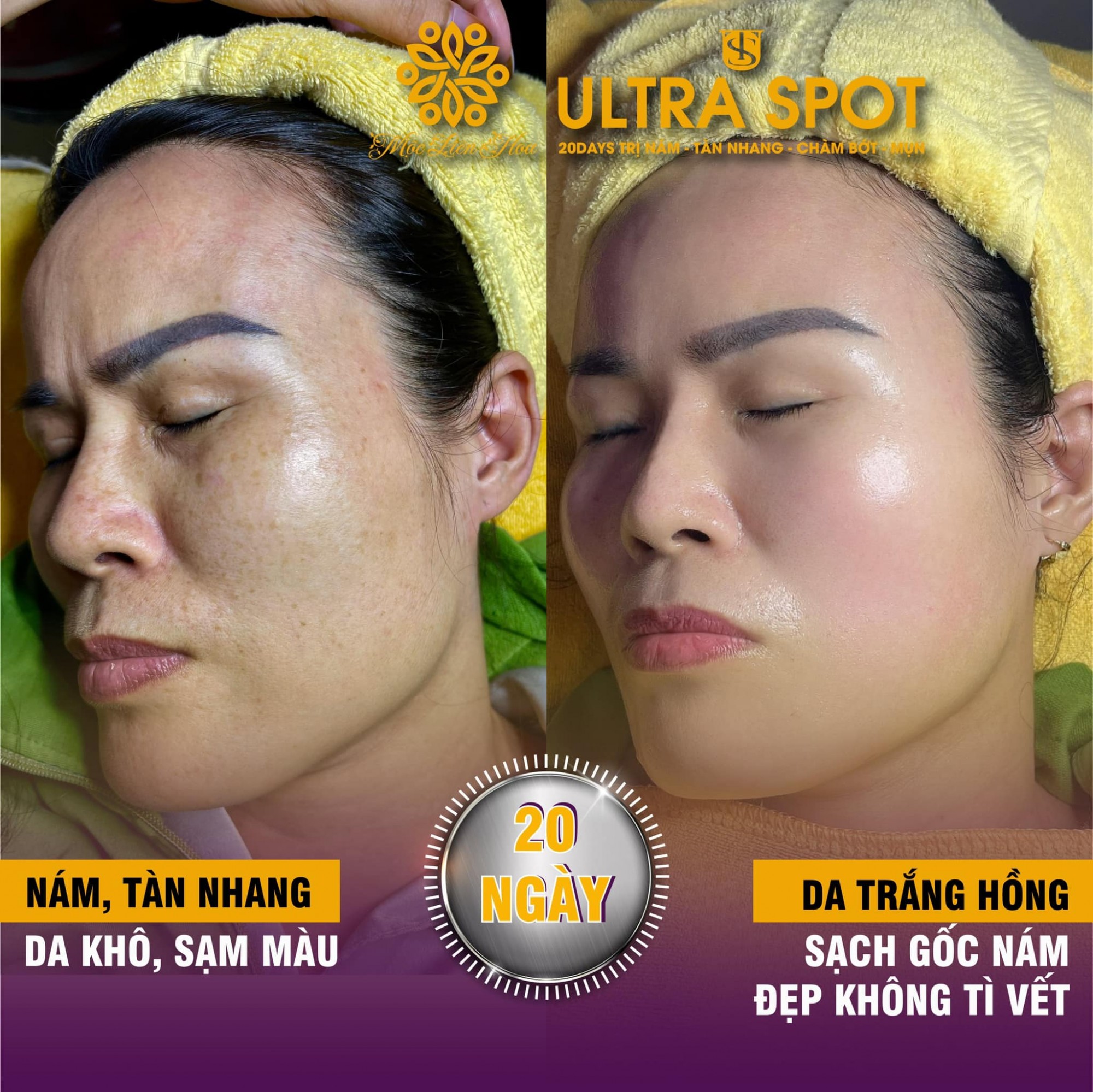 nam tan nhang ultra spot