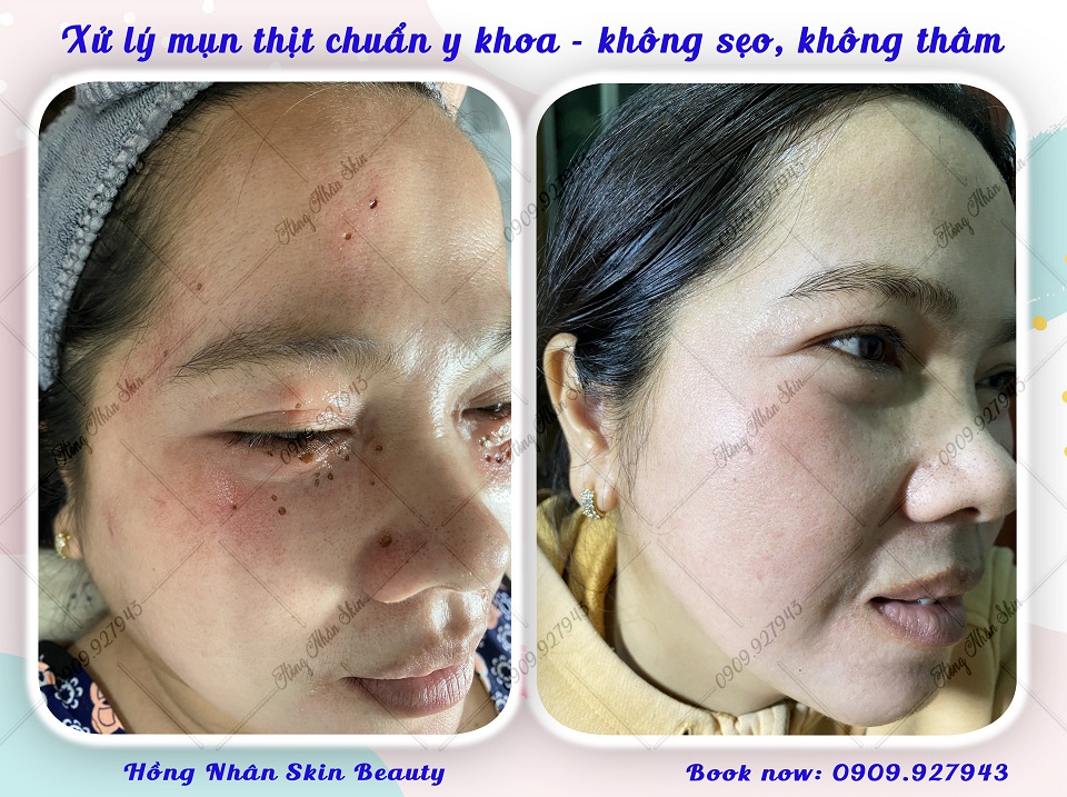 mun thit hns 2 web