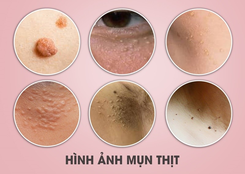 CA MỤN THỊT