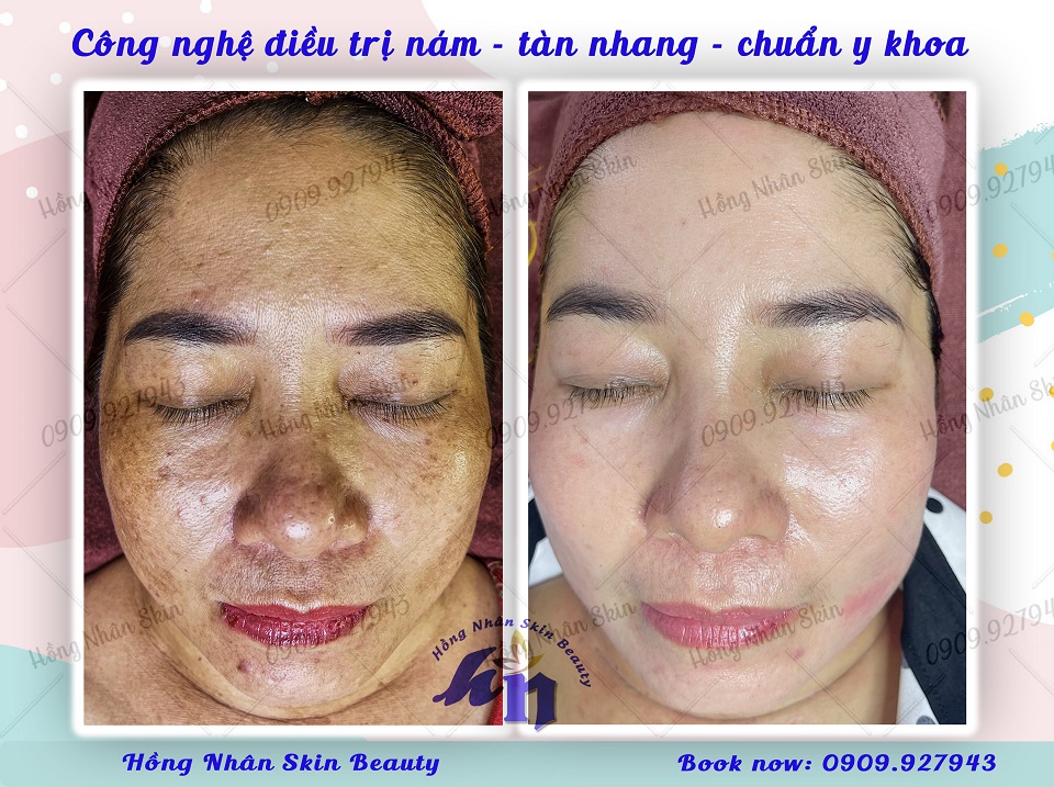 nam mang tan nhang hns 040423 chinh dien w