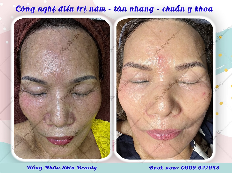 tai sinh lan da hns web