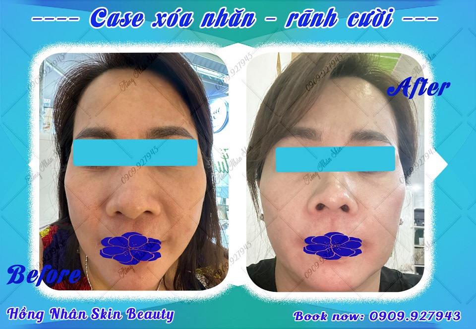 tiem chi hue copy