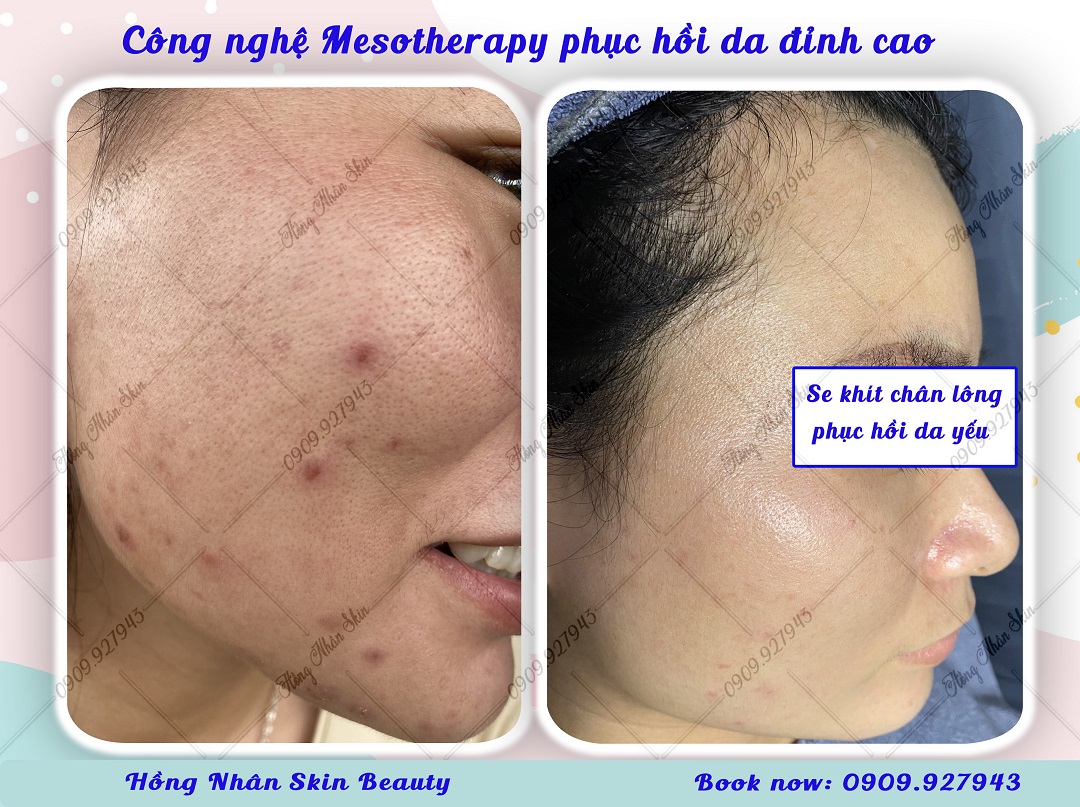 tai sinh lan da hns web