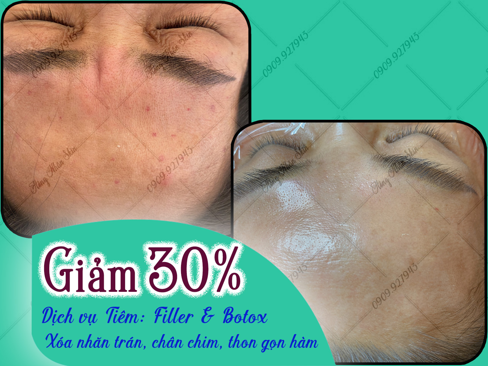km tiem filer botox hns