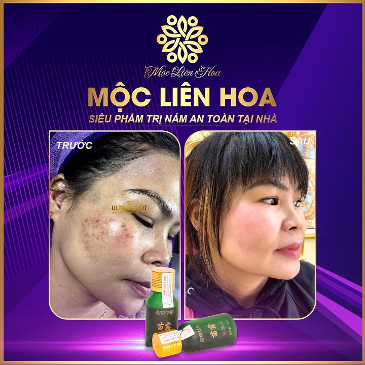 moc lien hoa 4